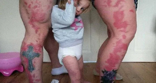 Μια Συγκινητική πράξη: Έκαναν τατουάζ τα σημάδια της κόρης τους για να μην νιώθει διαφορετική (φωτό)