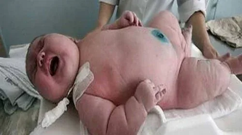 Μητέρα 272 κιλών…. γέννησε το μεγαλύτερο μωρό στο κόσμο