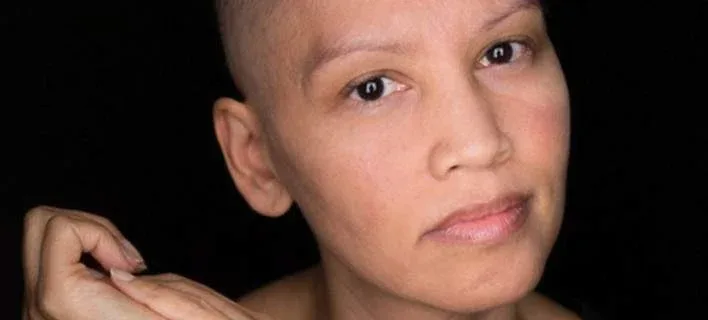ΞΕΔΙΠΛΩΣΑΝ ΤΑ ΣΥΝΑΙΣΘΗΜΑΤΑ ΤΟΥΣ Tο πρόσωπο της χημειοθεραπείας -Καρκινοπαθείς φωτογραφίζονται και δείχνουν τα σημάδια της και τις ουλές τους [εικόνες]
