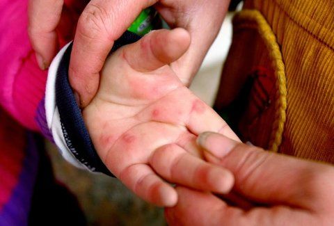 ΜΕΓΑΛΗ ΠΡΟΣΟΧΗ: Ο ιός Κοξάκι σε έξαρση στα παιδιά! Δείτε πώς να προφυλαχθείτε