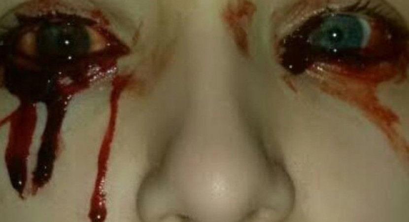 ΣΟΚ με 17χρονη: Τρέχει συνεχώς αίμα από τα μάτια και τα αυτιά της – Άναυδοι οι γιατροί (Photos)