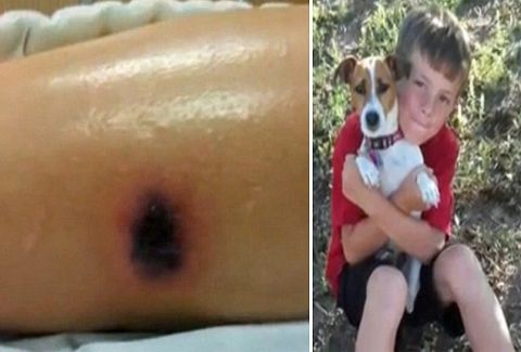 Τραγικό: Ένα μικρό αγόρι πέθανε δύο εβδομάδες αφού εμφανίστηκε αυτό το παράξενο σημάδι στο πόδι του!