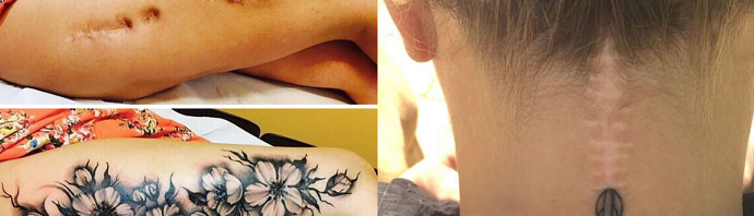 40 εκπληκτικά τατουάζ που μετατρέπουν ουλές σε έργα τέχνης
