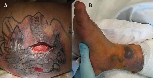 Νεκρός 31χρονος από σαρκοφάγο βακτήριο – Μολύνθηκε το φρέσκο τατουάζ του